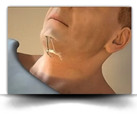 Airlift procedure