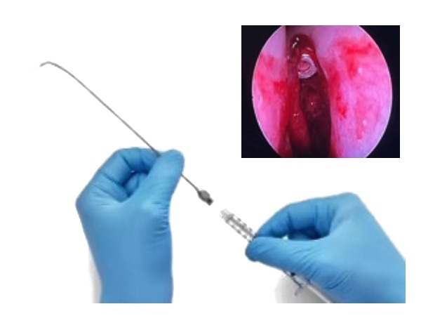 Hemostasis VECTRA F™DRUG DELIVERY MICRO-SPONGE