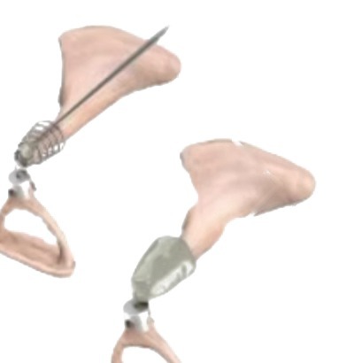 Ossicular Prostheses
